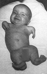 Thalidomide infant