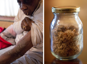 Rollins Edwards, who lives in Summerville, S.C., shows one of his many scars from exposure to mustard gas in World War II military experiments. More than 70 years after the exposure, his skin still falls off in flakes. For years, he carried around a jar full of the flakes to try to convince people of what happened to him.